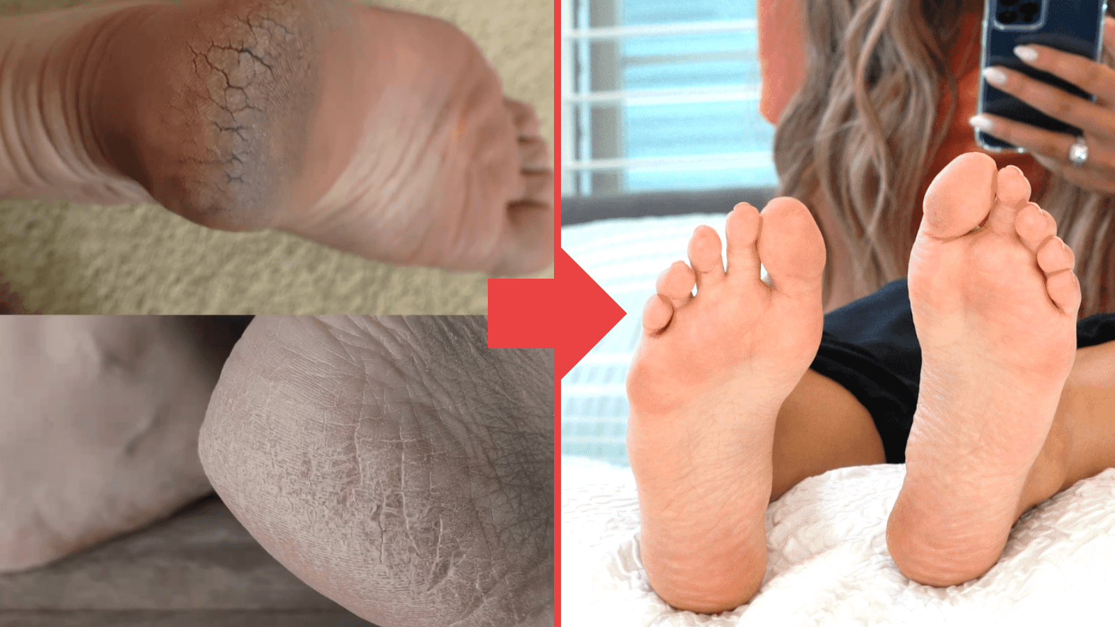 Here's How Anyone Can Turn Dry, Cracked, Unsightly Feet into Baby Soft GLOWING Feet in 1 Hour