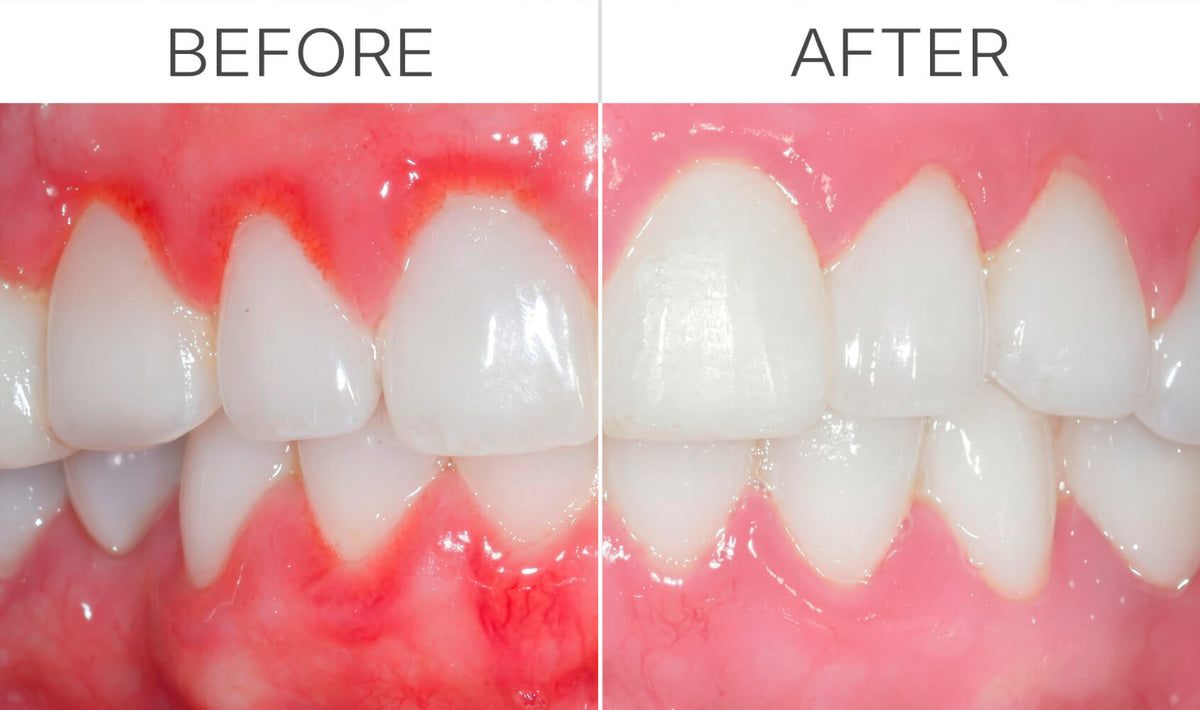 Your Electric or Even Regular Toothbrush Is Quietly Damaging Your Gums (Here's What You Need To Do...)