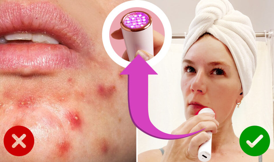Lux Spot LED Acne Treatment by reVive Light Therapy - BEing WELL