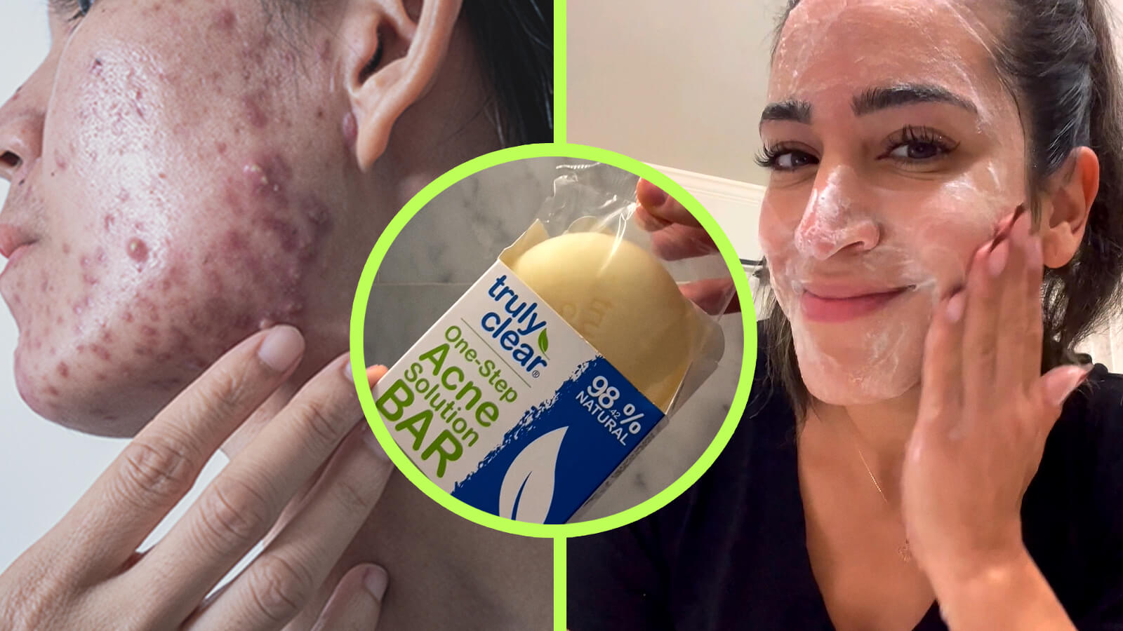 How to Clear Acne With Just 1 Step Truly Clear Review