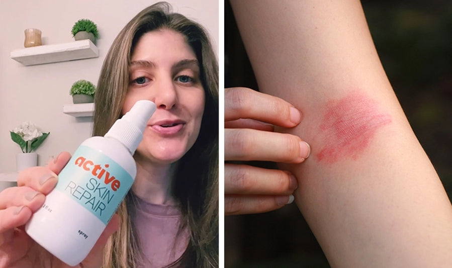 This New "Miracle Spray" Can Provide All Natural Eczema Relief Fast