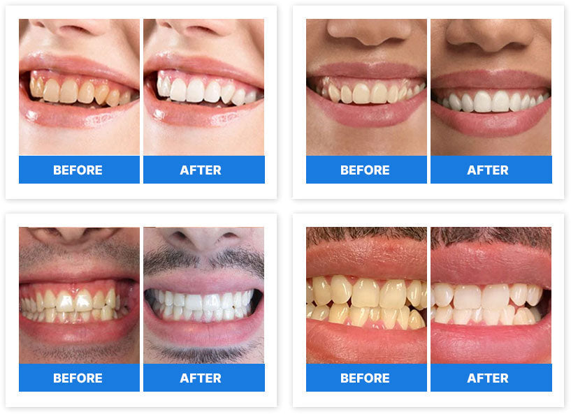Hiding Your Smile Is Not The Answer — Here's How To Whiten Teeth With No Pain, No Mess and No Complicated Routine